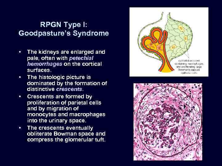 RPGN Type I: Goodpasture’s Syndrome • • The kidneys are enlarged and pale, often