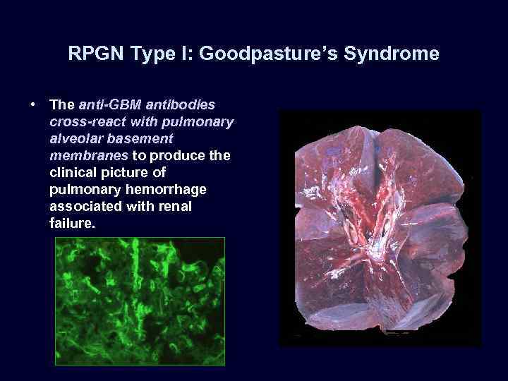 RPGN Type I: Goodpasture’s Syndrome • The anti-GBM antibodies cross-react with pulmonary alveolar basement
