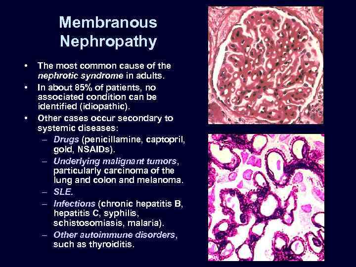 Membranous Nephropathy • • • The most common cause of the nephrotic syndrome in
