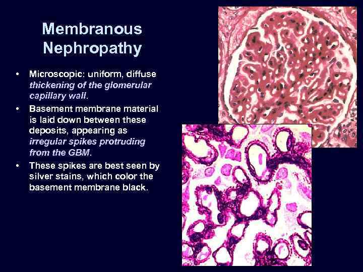 Membranous Nephropathy • • • Microscopic: uniform, diffuse thickening of the glomerular capillary wall.
