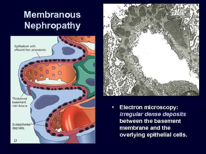 Membranous Nephropathy • Electron microscopy: irregular dense deposits between the basement membrane and the