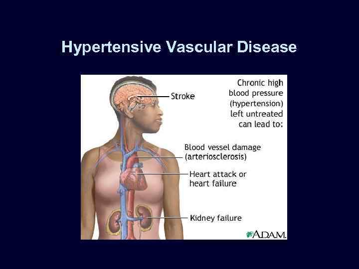 Hypertensive Vascular Disease 