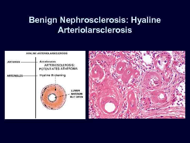 Benign Nephrosclerosis: Hyaline Arteriolarsclerosis 