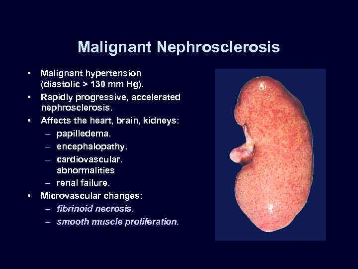 Malignant Nephrosclerosis • • Malignant hypertension (diastolic > 130 mm Hg). Rapidly progressive, accelerated