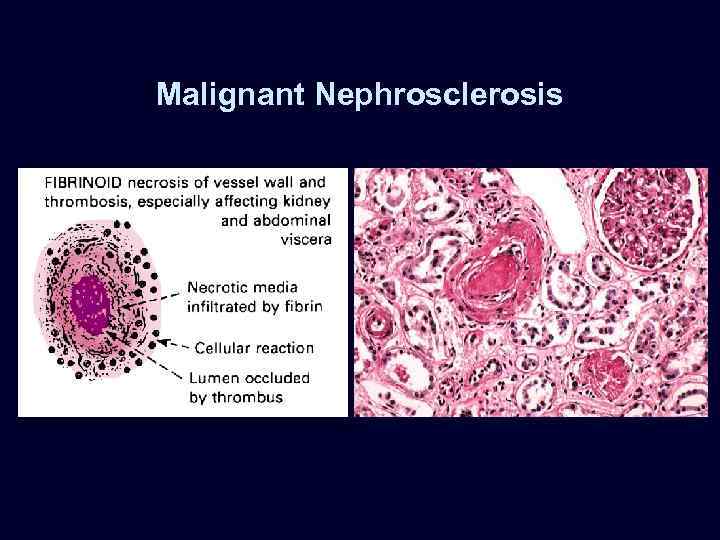 Malignant Nephrosclerosis 
