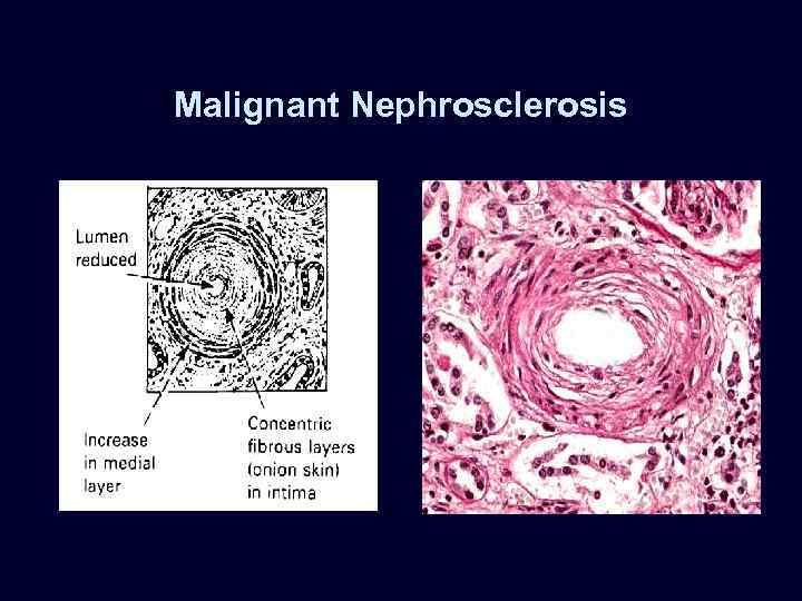 Malignant Nephrosclerosis 