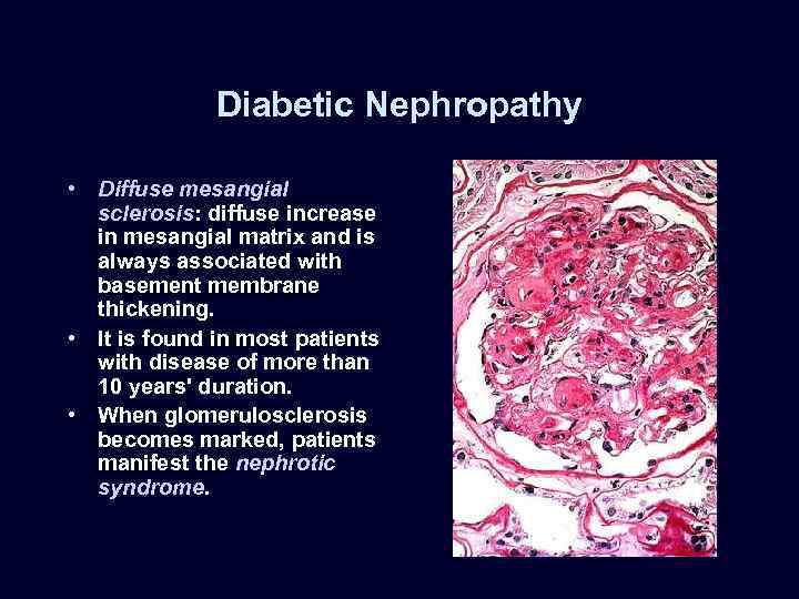 Diabetic Nephropathy • Diffuse mesangial sclerosis: diffuse increase in mesangial matrix and is always