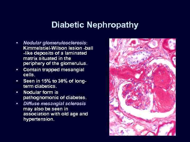 Diabetic Nephropathy • • • Nodular glomerulosclerosis: Kimmelstiel-Wilson lesion -ball -like deposits of a