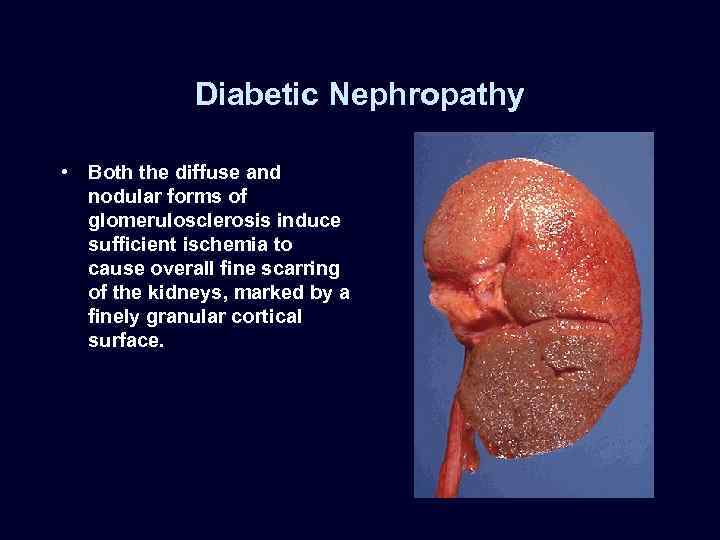 Diabetic Nephropathy • Both the diffuse and nodular forms of glomerulosclerosis induce sufficient ischemia