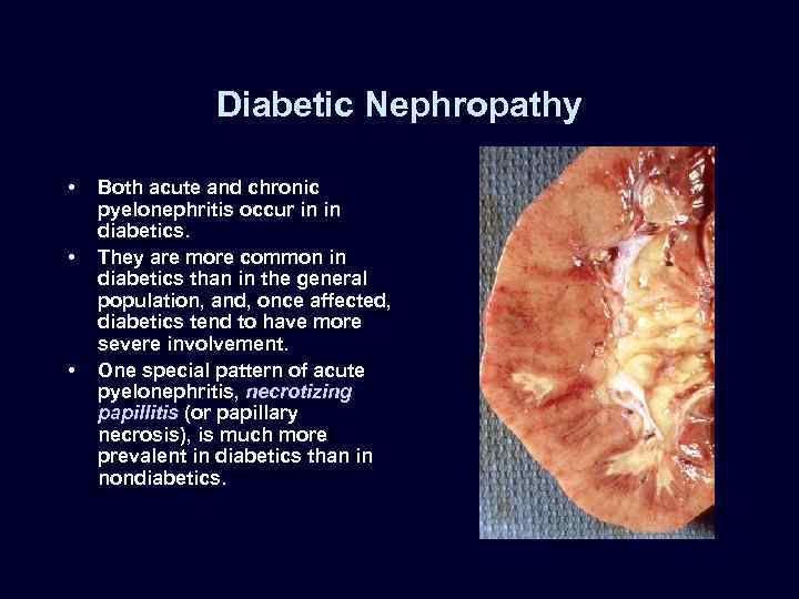 Diabetic Nephropathy • • • Both acute and chronic pyelonephritis occur in in diabetics.