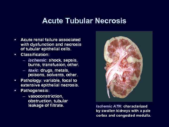 Acute Tubular Necrosis • • Acute renal failure associated with dysfunction and necrosis of