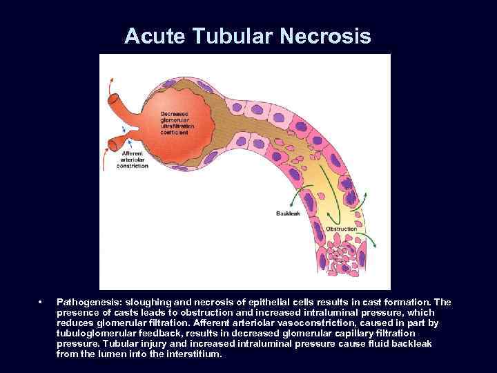 Acute Tubular Necrosis • Pathogenesis: sloughing and necrosis of epithelial cells results in cast