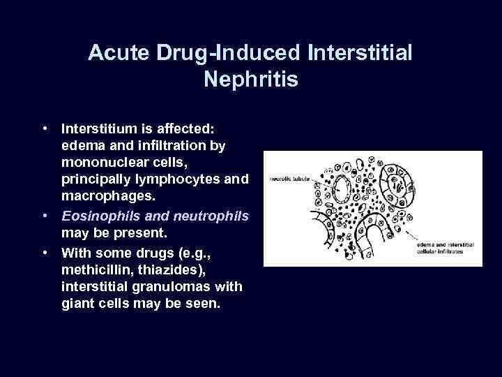 Acute Drug-Induced Interstitial Nephritis • Interstitium is affected: edema and infiltration by mononuclear cells,