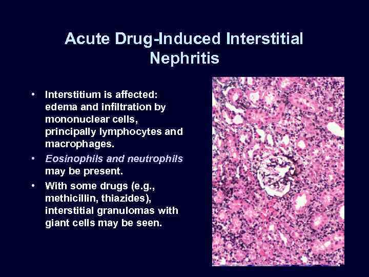 Acute Drug-Induced Interstitial Nephritis • Interstitium is affected: edema and infiltration by mononuclear cells,