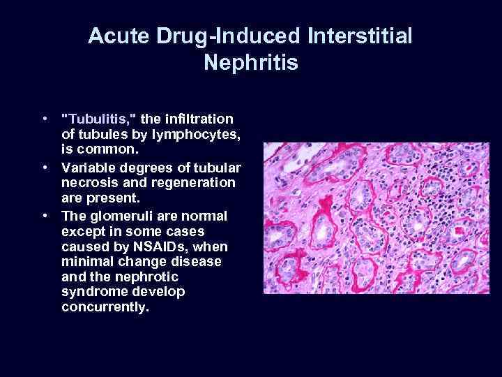 Acute Drug-Induced Interstitial Nephritis • "Tubulitis, " the infiltration of tubules by lymphocytes, is