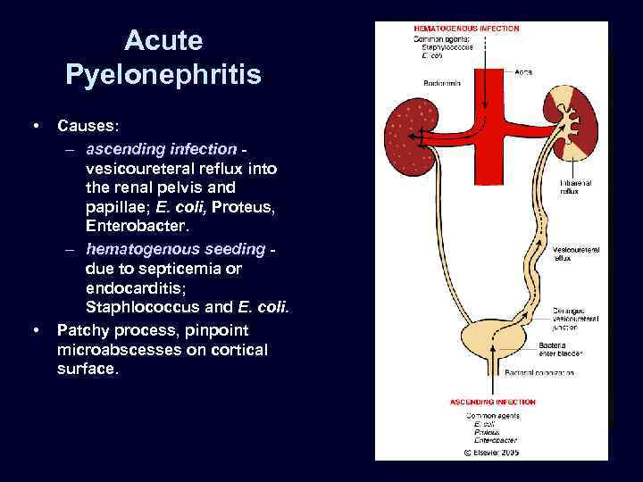 Acute Pyelonephritis • • Causes: – ascending infection vesicoureteral reflux into the renal pelvis