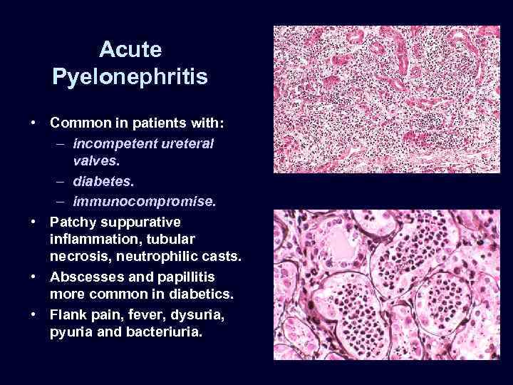 Acute Pyelonephritis • Common in patients with: – incompetent ureteral valves. – diabetes. –