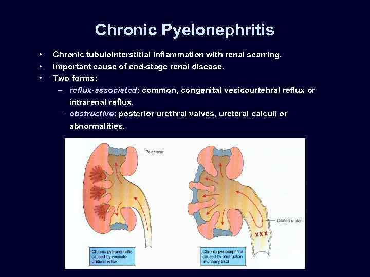 Chronic Pyelonephritis • • • Chronic tubulointerstitial inflammation with renal scarring. Important cause of