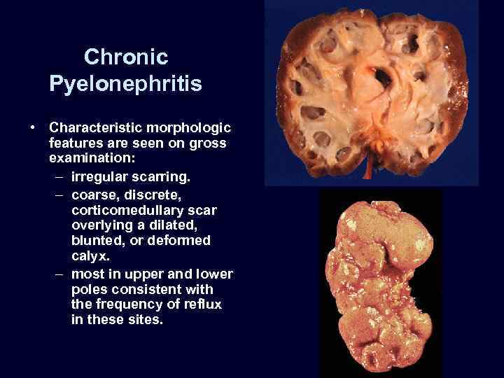Chronic Pyelonephritis • Characteristic morphologic features are seen on gross examination: – irregular scarring.