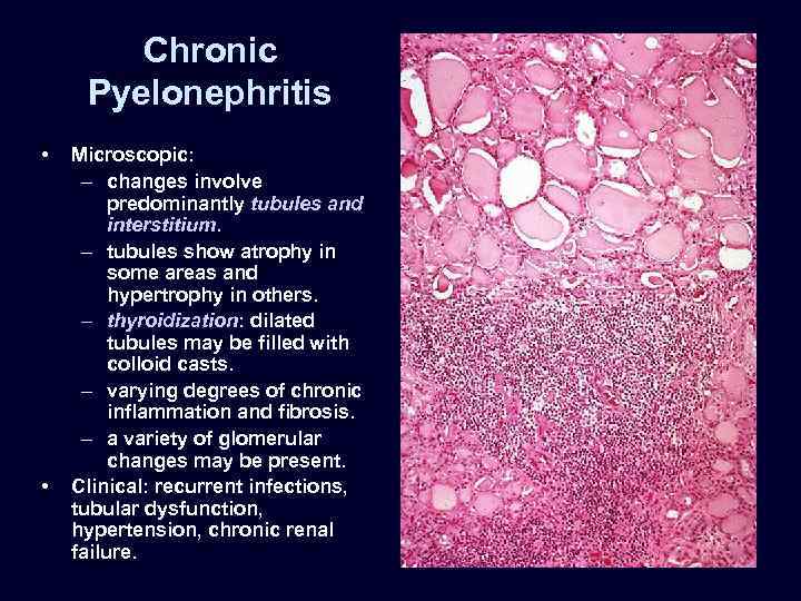 Chronic Pyelonephritis • • Microscopic: – changes involve predominantly tubules and interstitium. – tubules