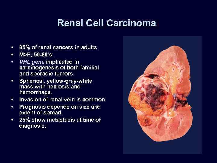 Renal Cell Carcinoma • • 85% of renal cancers in adults. M>F; 50 -60’s.