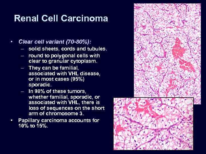 Renal Cell Carcinoma • Clear cell variant (70 -80%): • – solid sheets, cords
