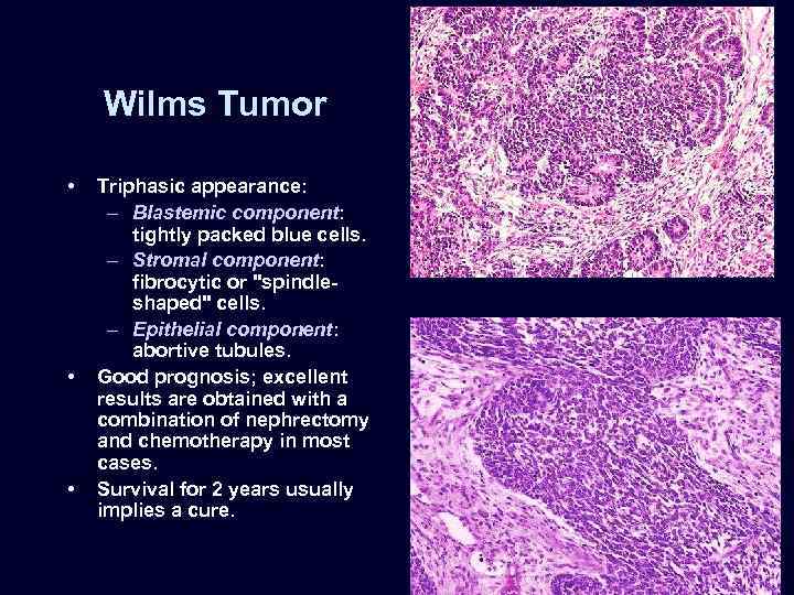 Wilms Tumor • • • Triphasic appearance: – Blastemic component: tightly packed blue cells.
