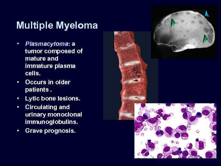 Multiple Myeloma • Plasmacytoma: a tumor composed of mature and immature plasma cells. •