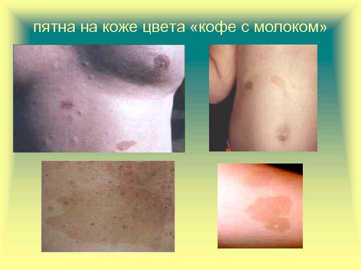 пятна на коже цвета «кофе с молоком» 