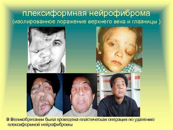 плексиформная нейрофиброма (изолированное поражение верхнего века и глазницы ) В Великобритании была проведена пластическая