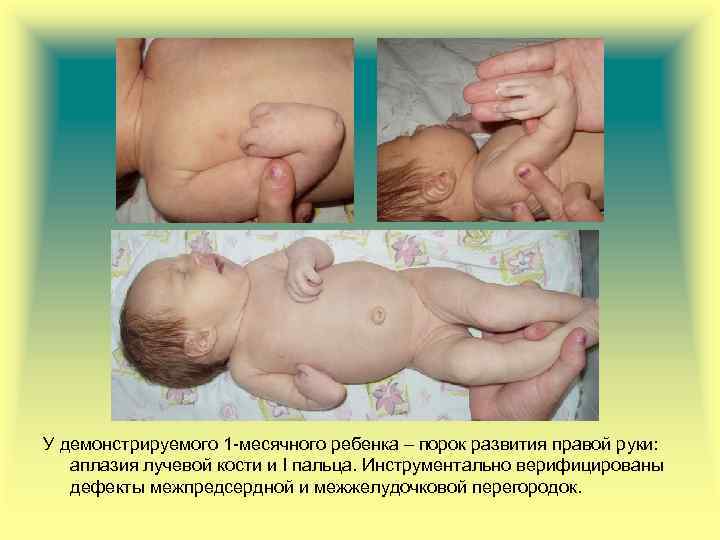 У демонстрируемого 1 -месячного ребенка – порок развития правой руки: аплазия лучевой кости и
