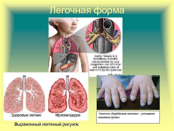Легочная форма Симптом «барабанные палочки» - утолщение концевых фаланг Выраженный легочный рисунок 