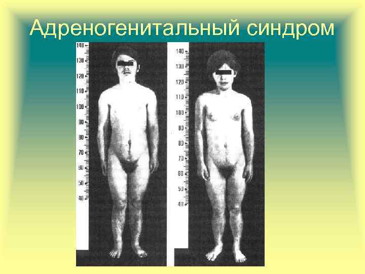 Адреногенитальный синдром 