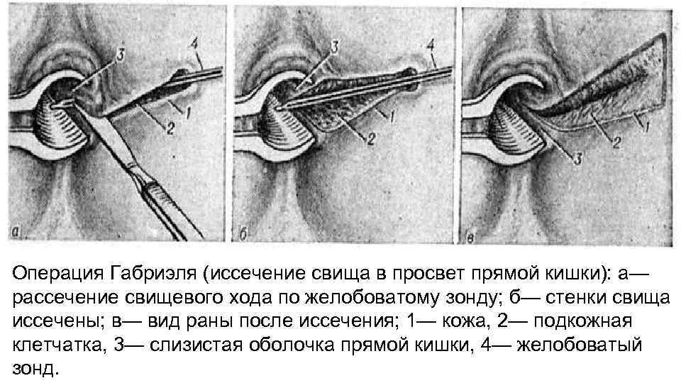 Операция Габриэля (иссечение свища в просвет прямой кишки): а— рассечение свищевого хода по желобоватому