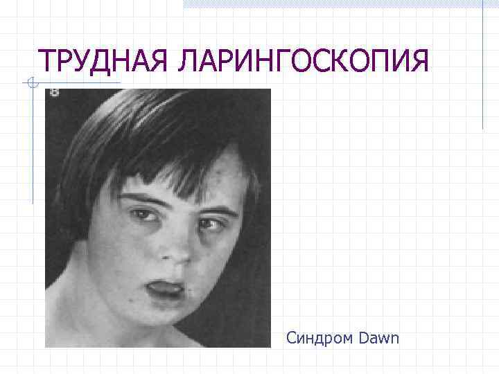 ТРУДНАЯ ЛАРИНГОСКОПИЯ Синдром Dawn 