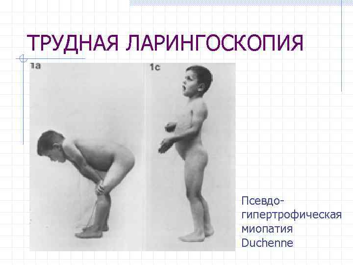 ТРУДНАЯ ЛАРИНГОСКОПИЯ Псевдогипертрофическая миопатия Duchenne 