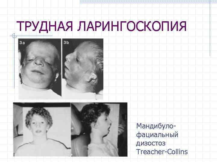 ТРУДНАЯ ЛАРИНГОСКОПИЯ Мандибулофациальный дизостоз Treacher-Collins 