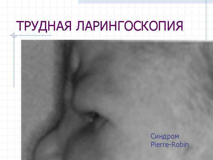 ТРУДНАЯ ЛАРИНГОСКОПИЯ Синдром Pierre-Robin 