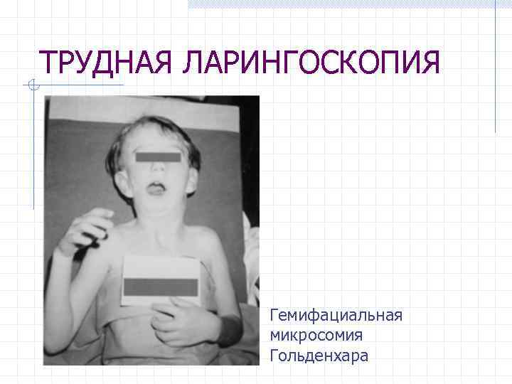 ТРУДНАЯ ЛАРИНГОСКОПИЯ Гемифациальная микросомия Гольденхара 
