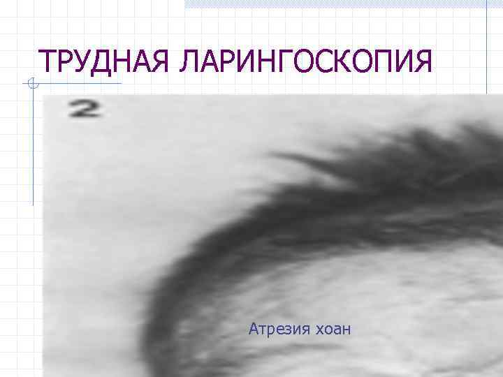 ТРУДНАЯ ЛАРИНГОСКОПИЯ Атрезия хоан 
