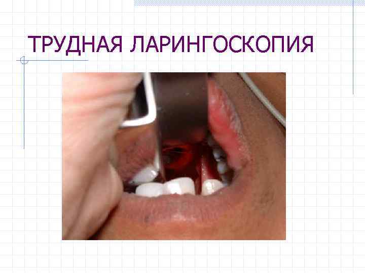 ТРУДНАЯ ЛАРИНГОСКОПИЯ 