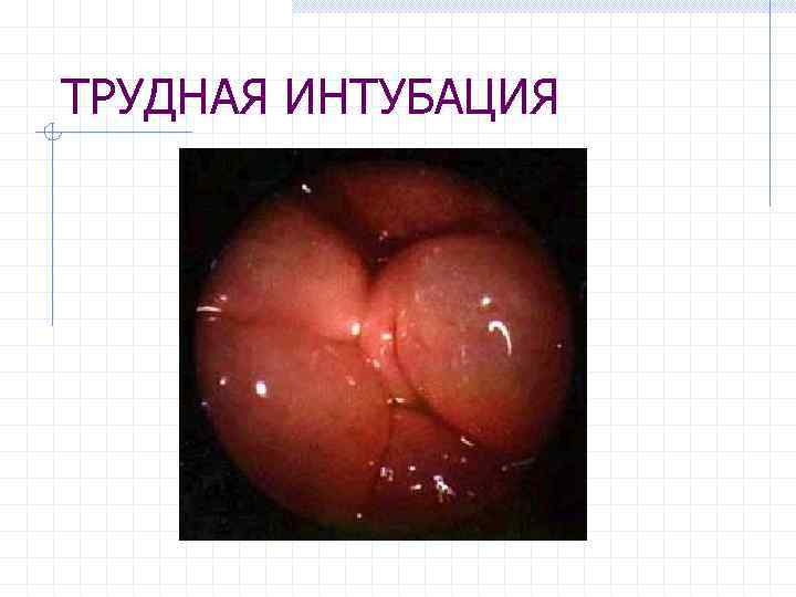 ТРУДНАЯ ИНТУБАЦИЯ 