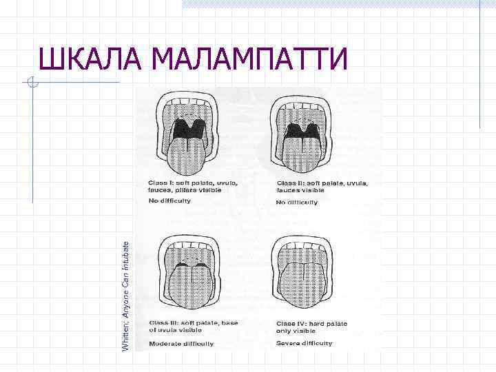 Whitten; Anyone Can Intubate ШКАЛА МАЛАМПАТТИ 