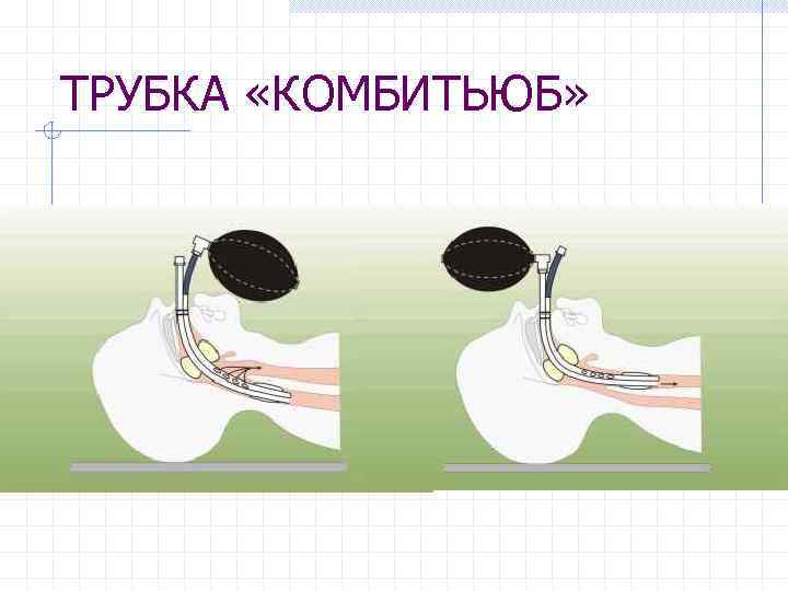 ТРУБКА «КОМБИТЬЮБ» 