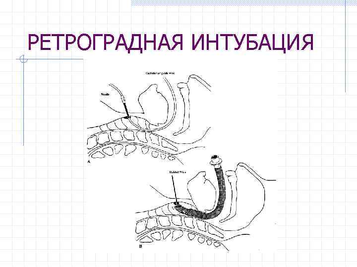 РЕТРОГРАДНАЯ ИНТУБАЦИЯ 