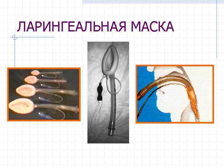 ЛАРИНГЕАЛЬНАЯ МАСКА 