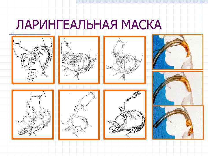 ЛАРИНГЕАЛЬНАЯ МАСКА 