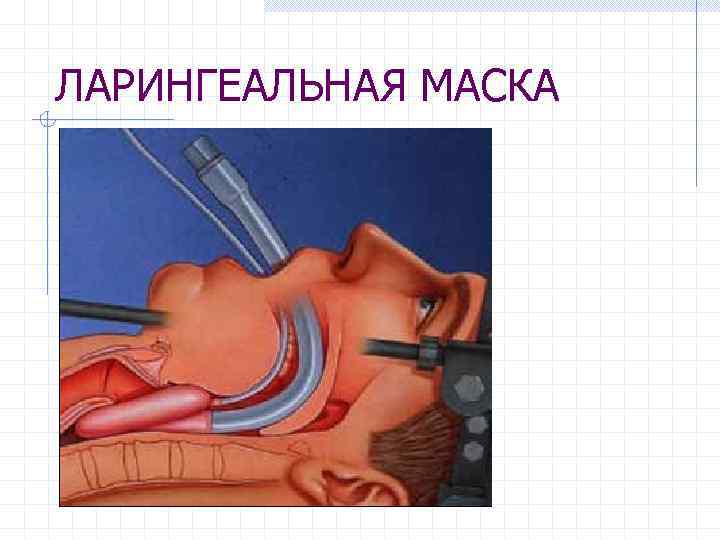 ЛАРИНГЕАЛЬНАЯ МАСКА 
