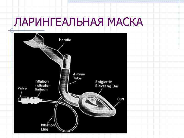 ЛАРИНГЕАЛЬНАЯ МАСКА 