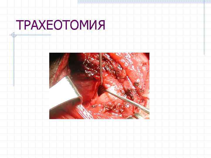 ТРАХЕОТОМИЯ 